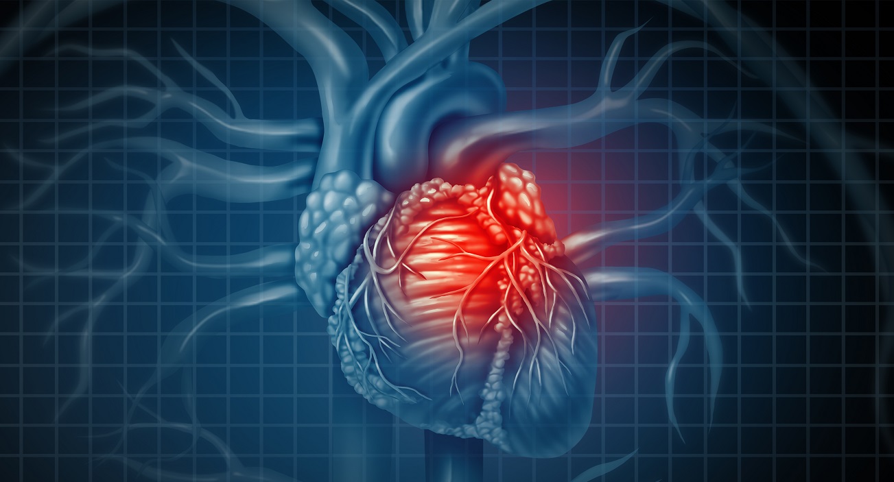 New 'Chronic Coronary Syndrome' Guidelines Stress There's Nothing Stable  About CAD | tctmd.com