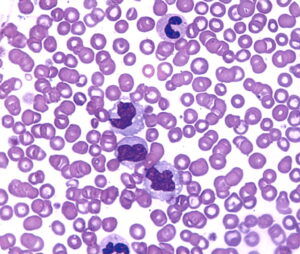 Understanding Neutrophil to Lymphocyte Ratio (Part 2): Research Demonstrating its Role as a Valuable Prognostic Marker in Cancer 2 F1.large