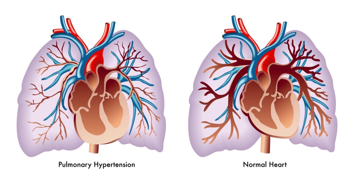 Getting it 'Right': Pulmonary Hypertension in the ED - EMOttawa Blog