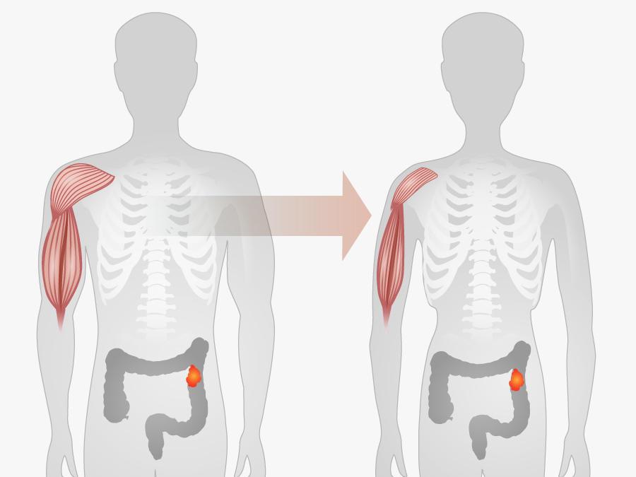 Illustration of muscle and fat wasting in cancer cachexia